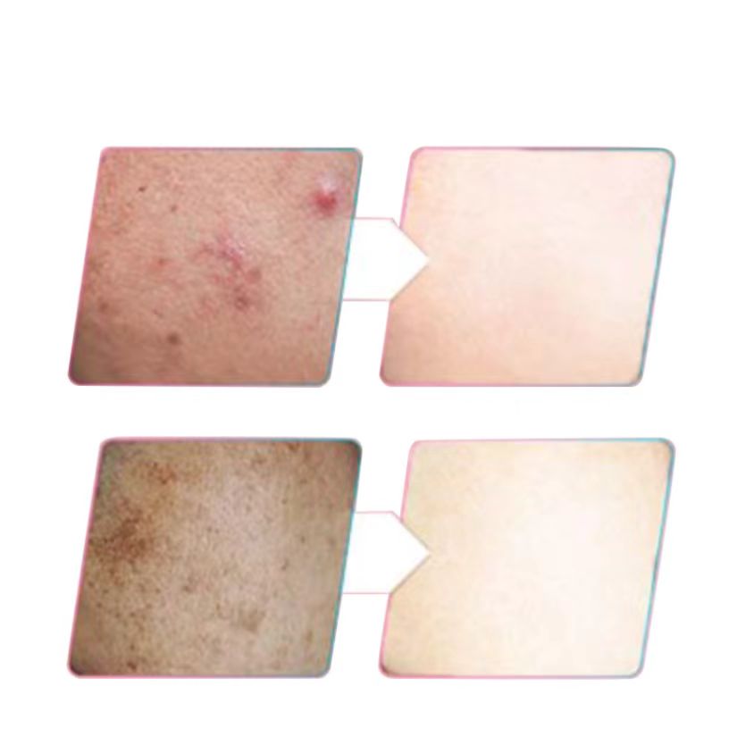 Skin whitening tea to remove acne smooth skin